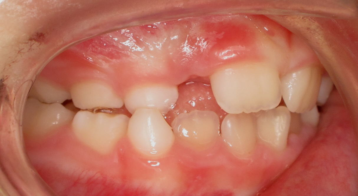 Posterior-Crossbite2