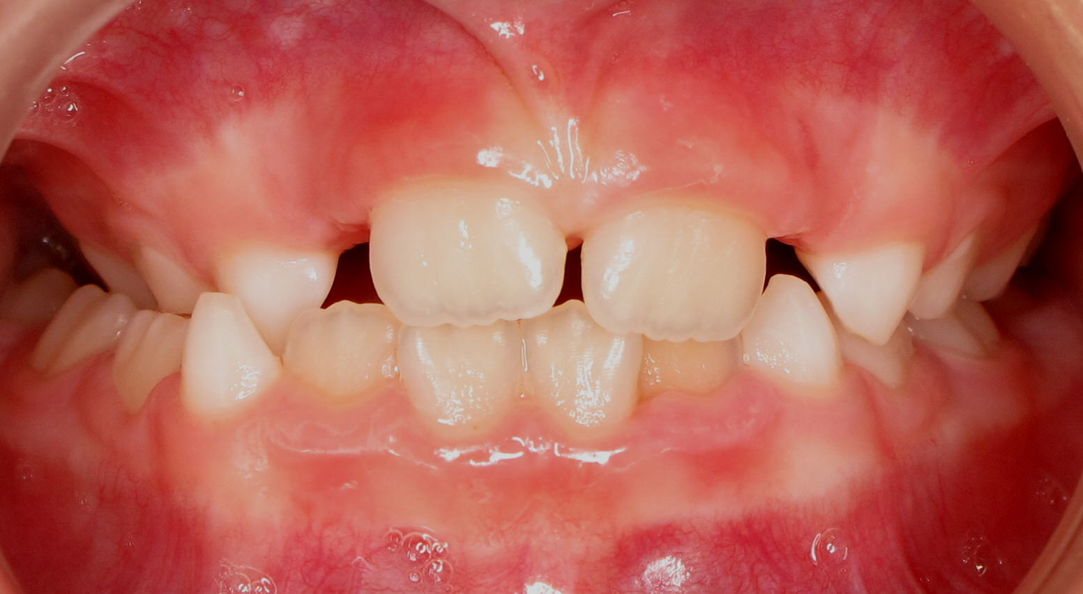 Posterior-Crossbite3