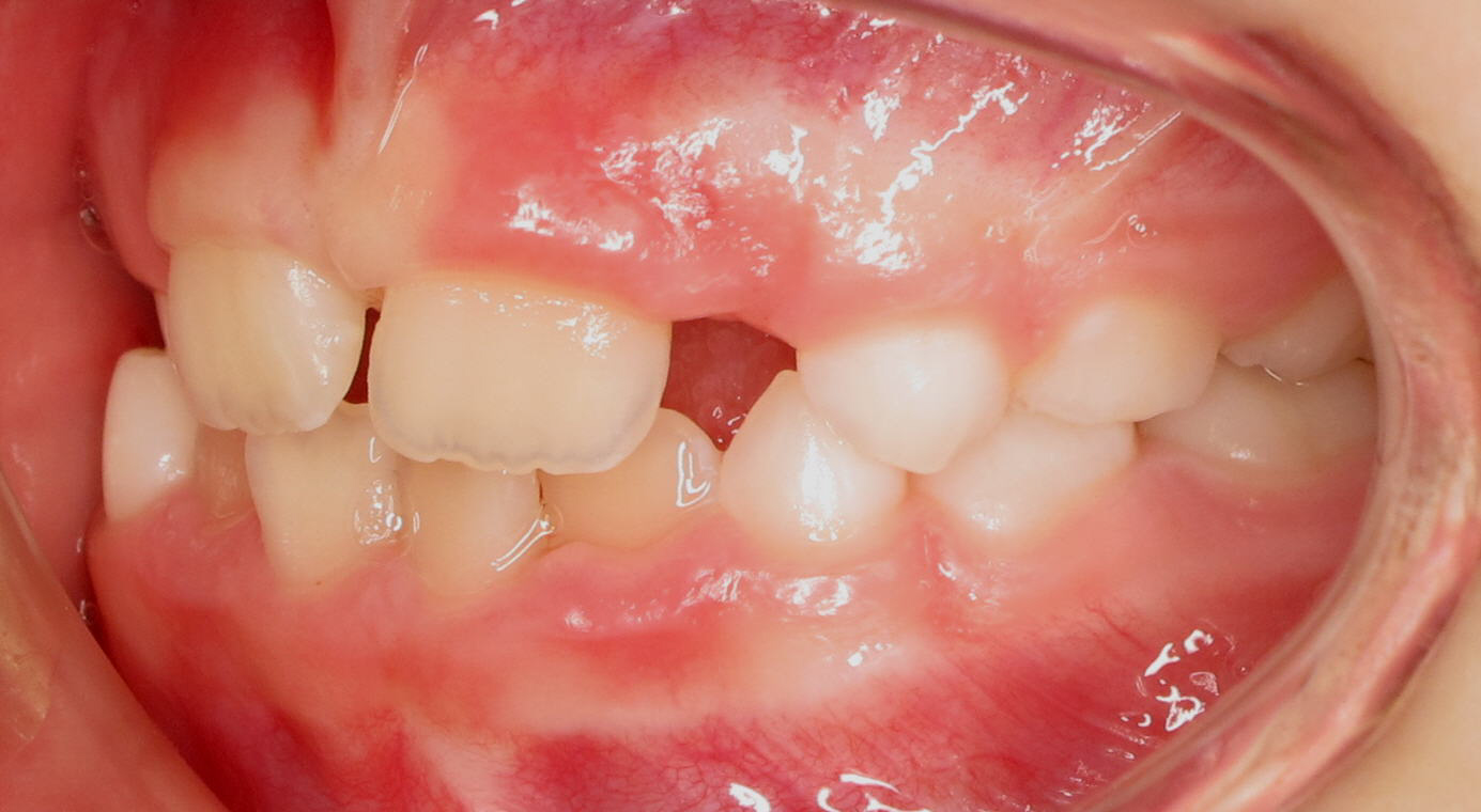 Posterior-Crossbite4