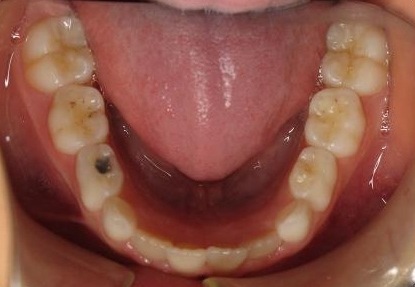 Anterior-Crossbite1