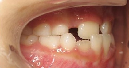 Anterior-Crossbite2