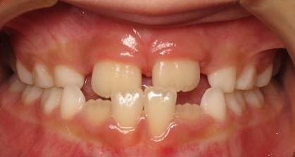 Anterior-Crossbite3