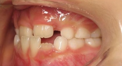 Anterior-Crossbite4