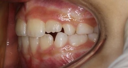 Anterior-Crossbite8