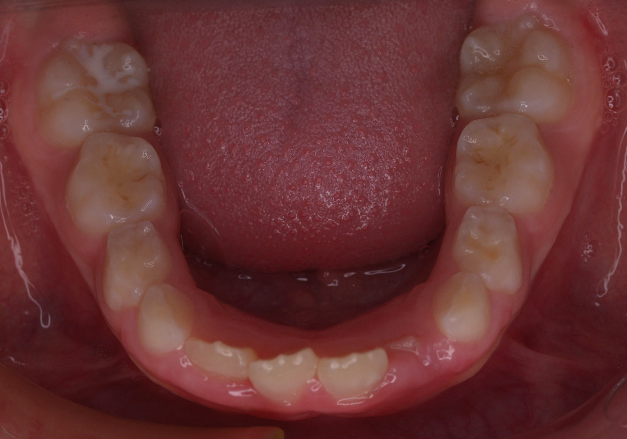 Anterior-Open-Bite1