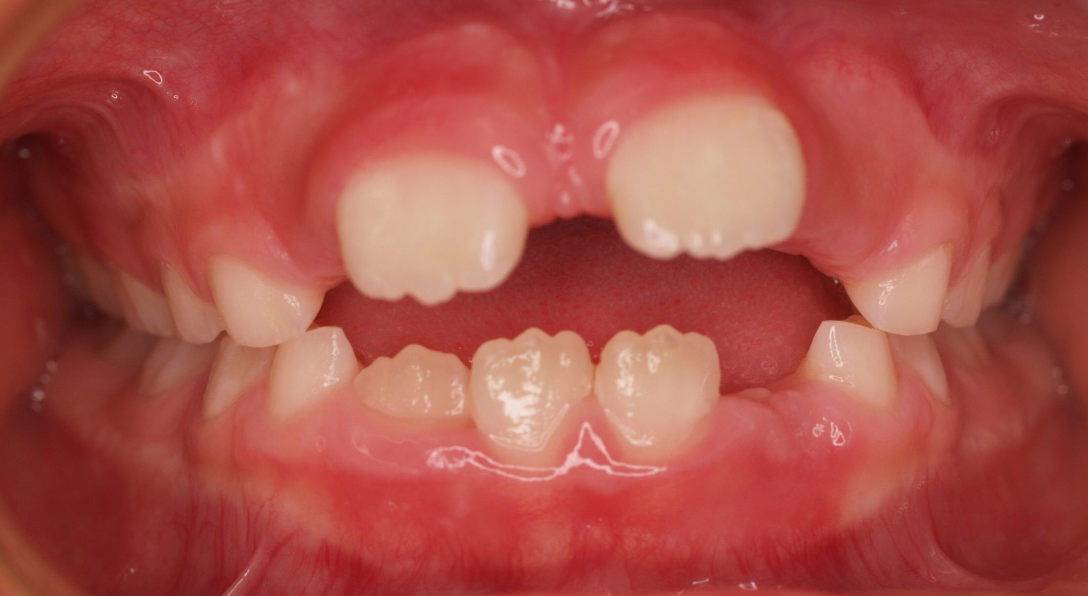 Early Treatment Gallery - PDG Dental | Pediatric Dentistry & Orthodontics