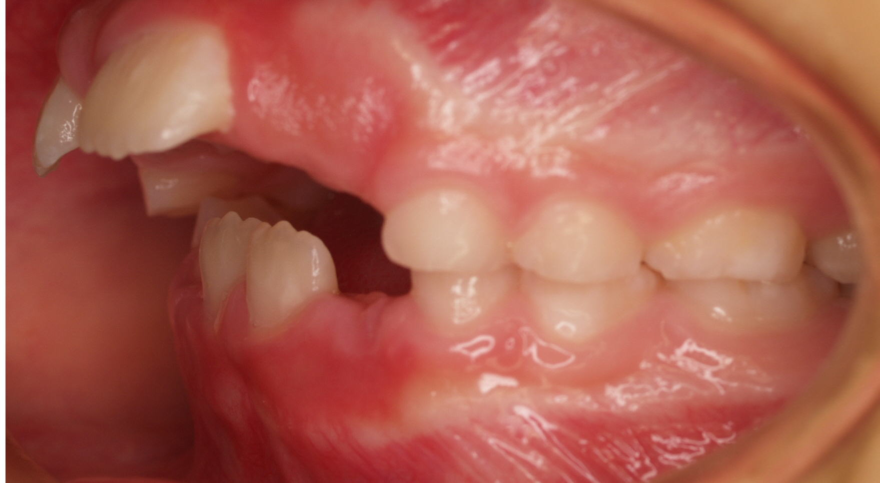 Anterior-Open-Bite4