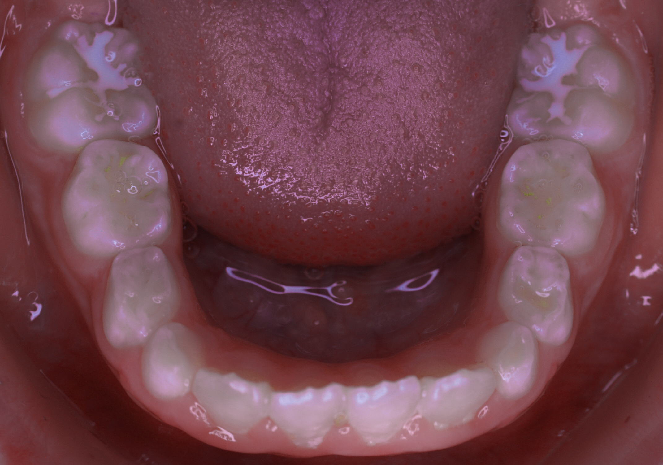 Anterior-Open-Bite5