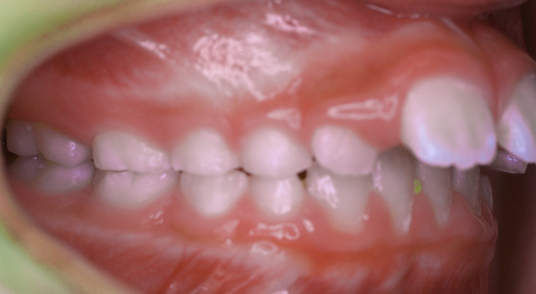 Anterior-Open-Bite6