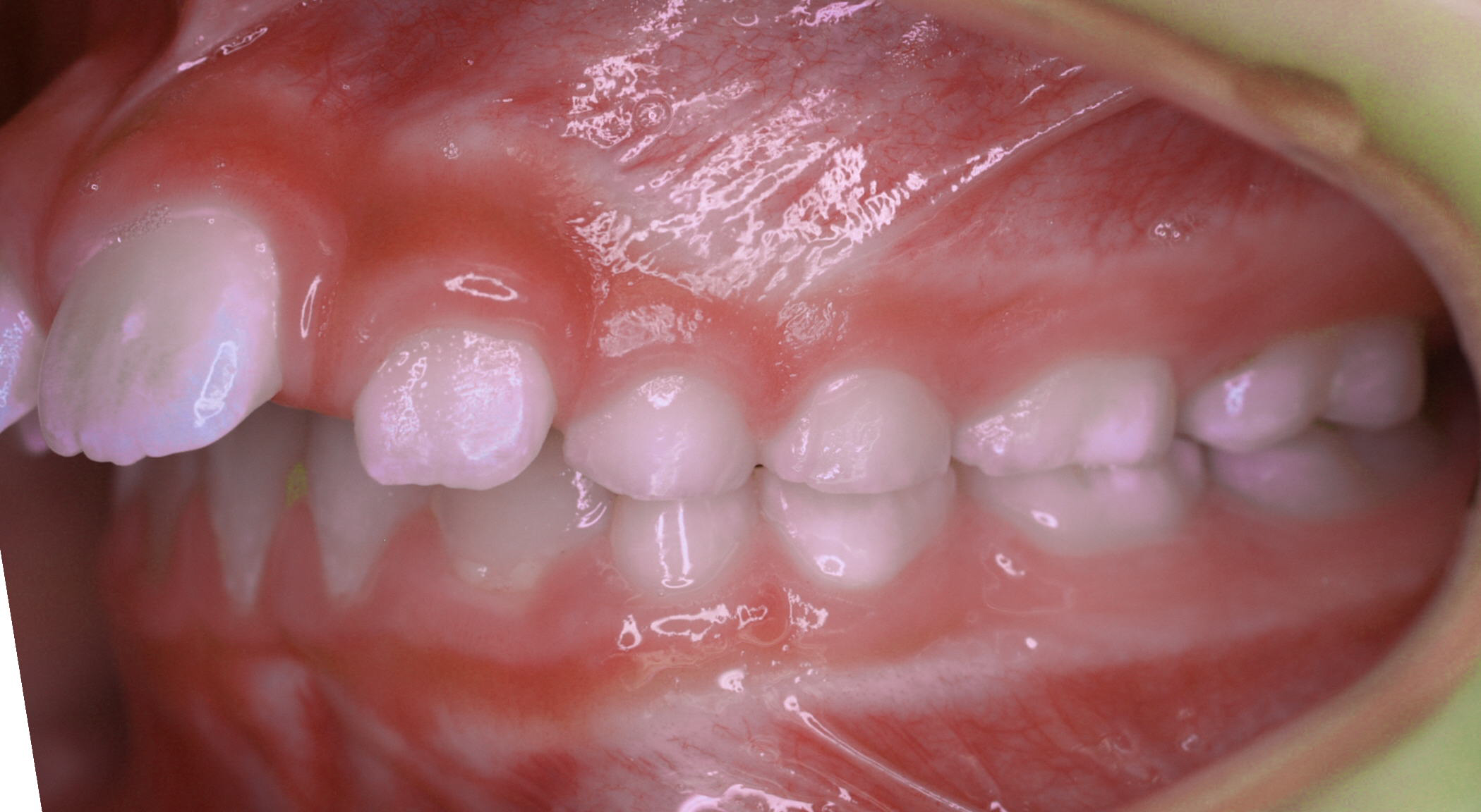 Anterior-Open-Bite8