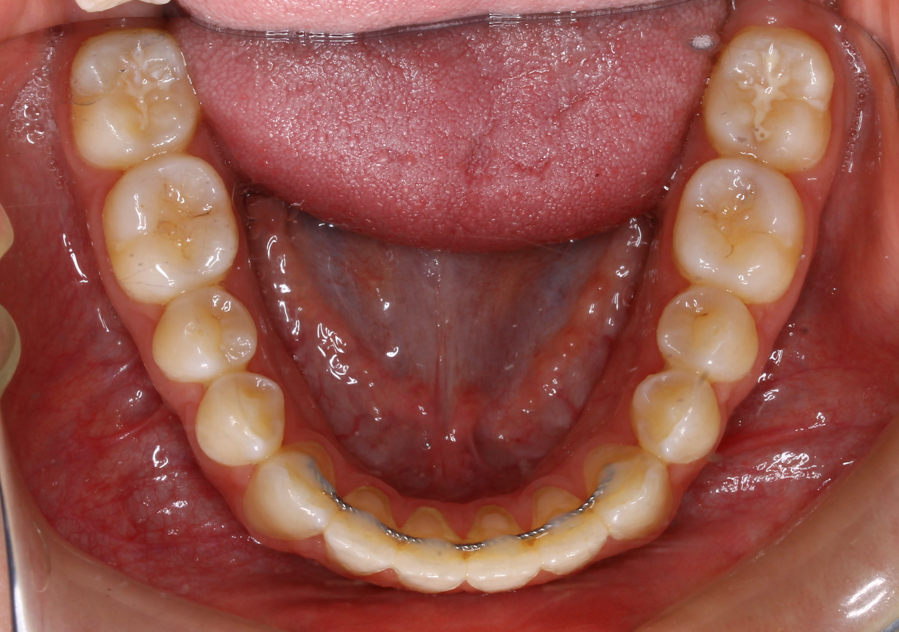 Crossbite-and-Negative-Overjet-02b-After