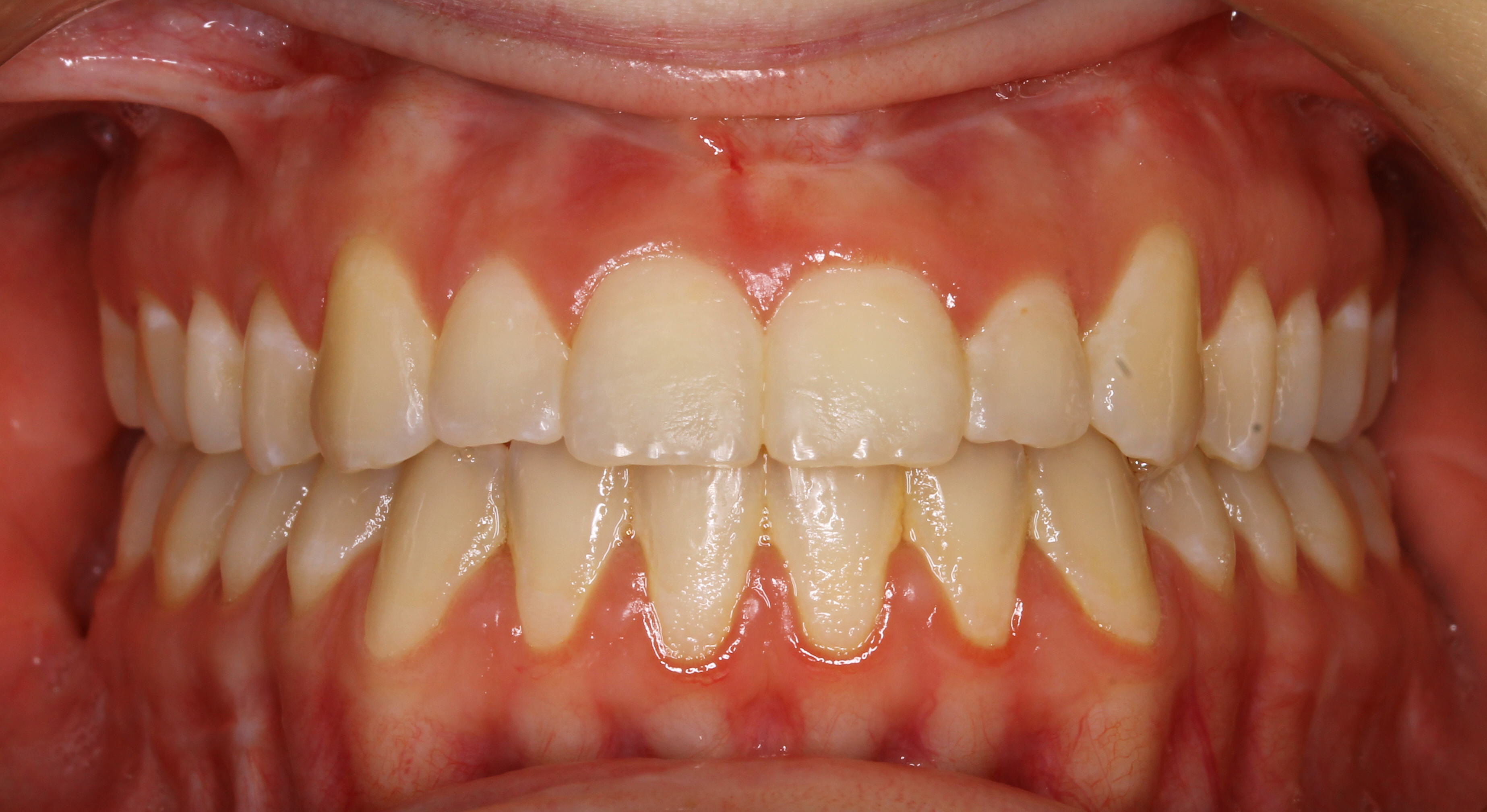 Crossbite-and-Negative-Overjet-02d-After