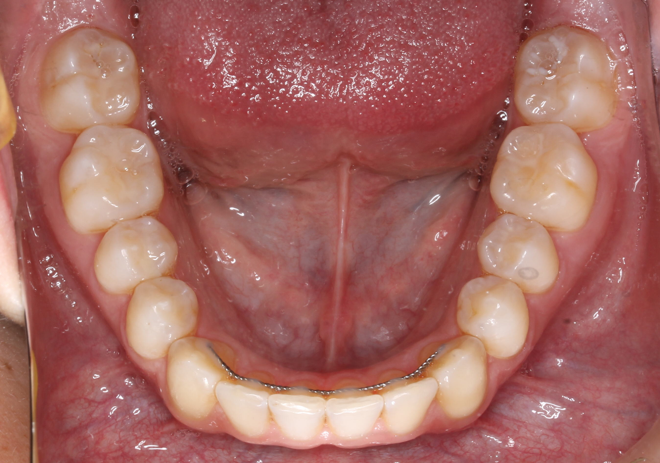 Invisalign-02b-After