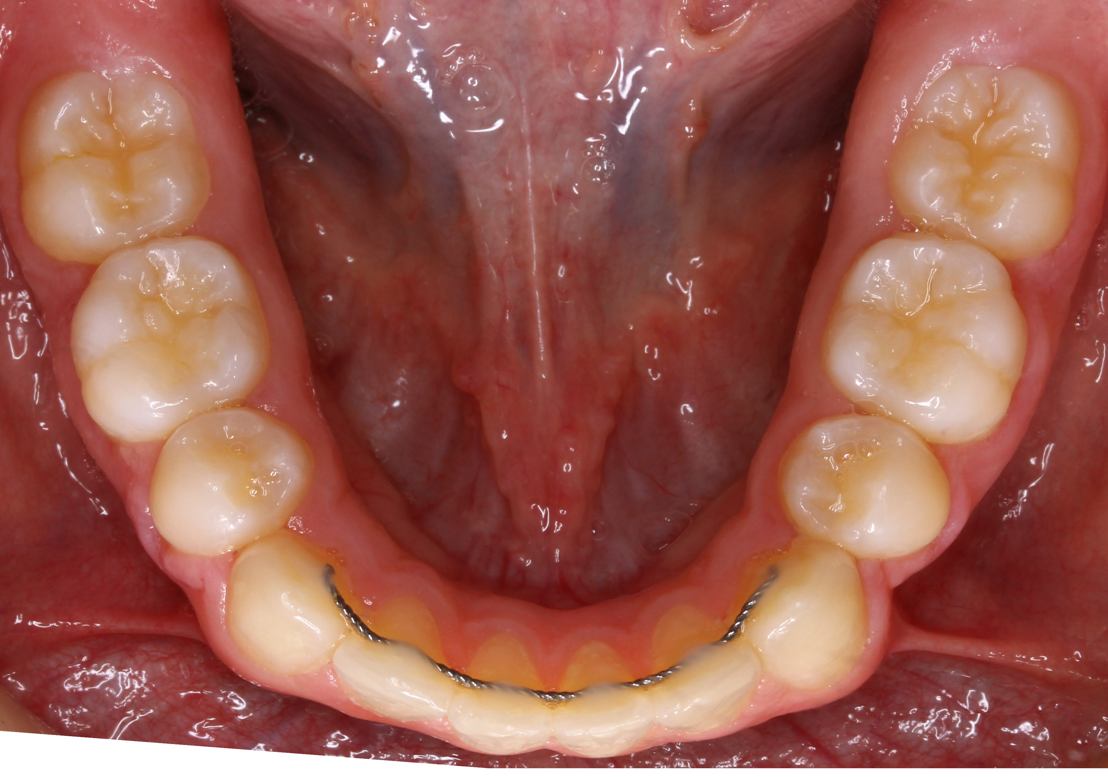 Overbite-and-Overjet-02b-After