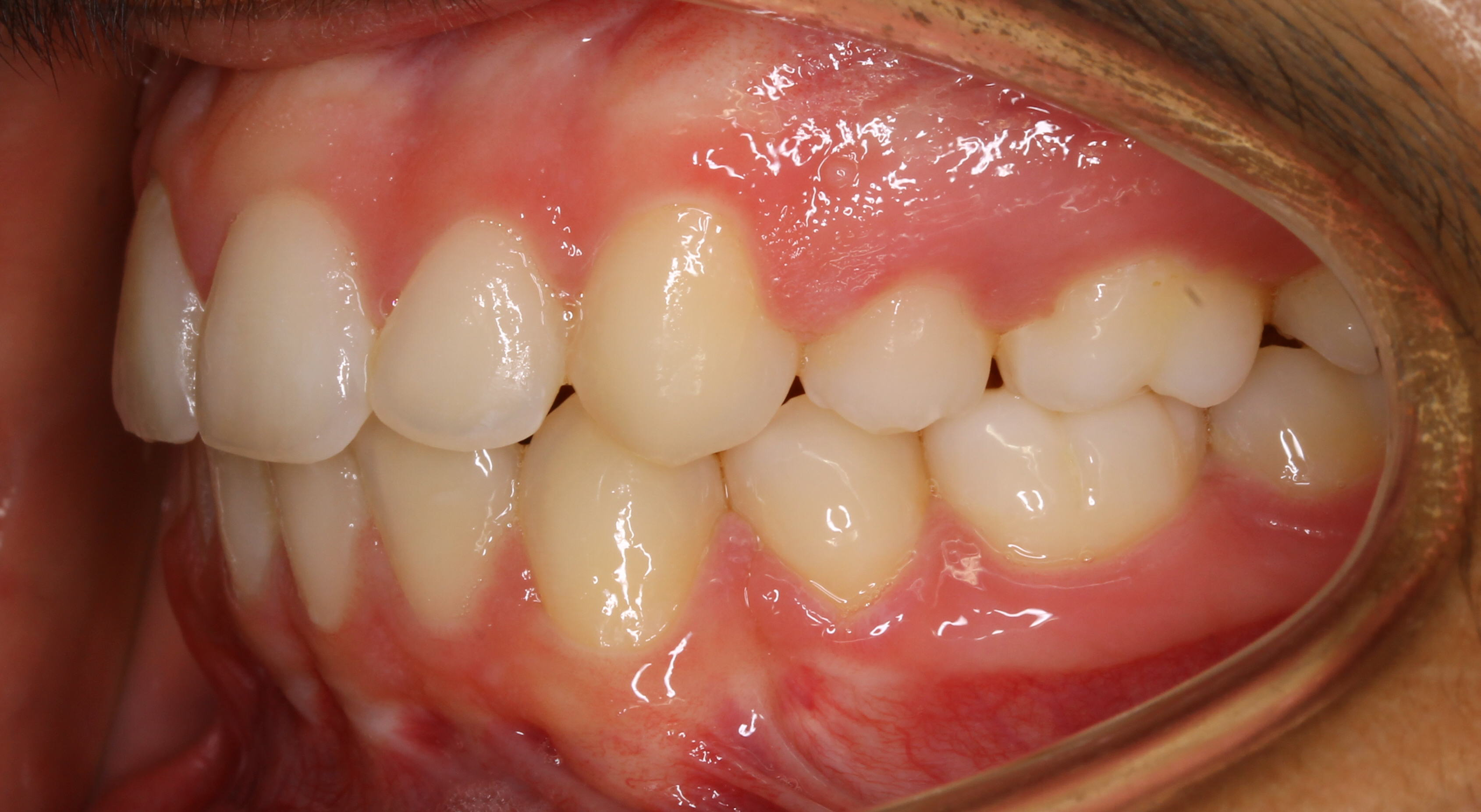 Overbite-and-Overjet-02e-After