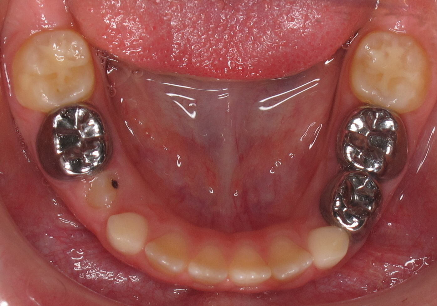 Protruted-Upper-Front-Teeth1
