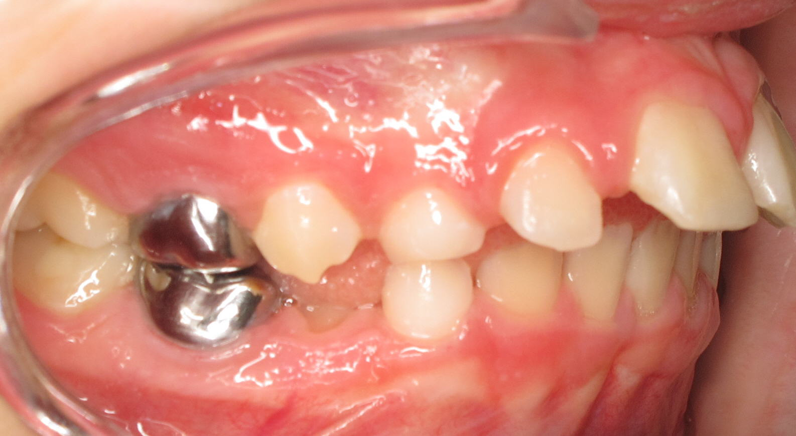 Protruted-Upper-Front-Teeth2