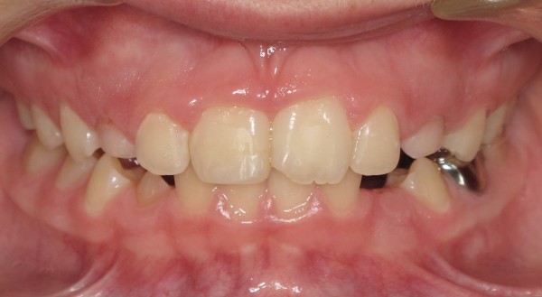 Protruted-Upper-Front-Teeth6