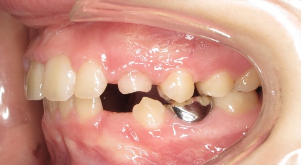 Protruted-Upper-Front-Teeth7