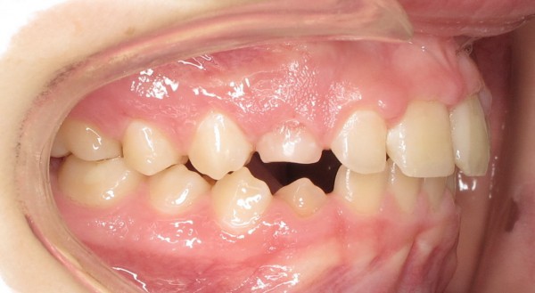 Protruted-Upper-Front-Teeth8
