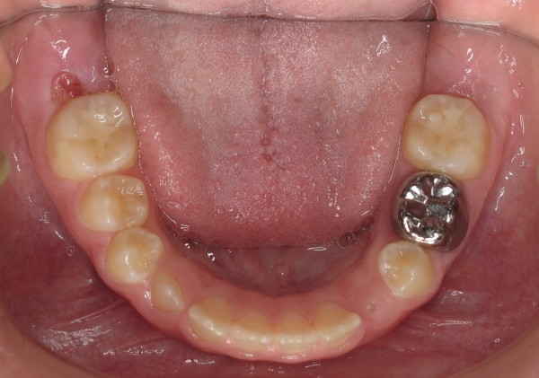 Protruted-Upper-Front-Teeth5