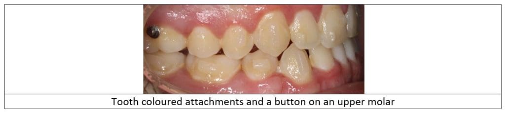 Invisalign Attachments PDG Dental Orthodontics