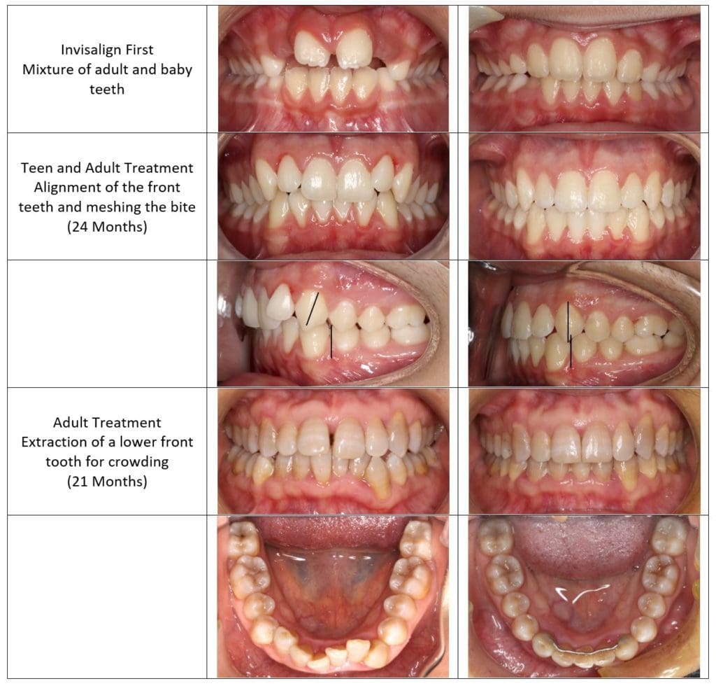 Child teens adults Invisalign before after PDG Orthodontics Dentist
